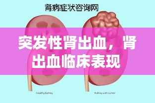 突发性肾出血,肾出血临床表现