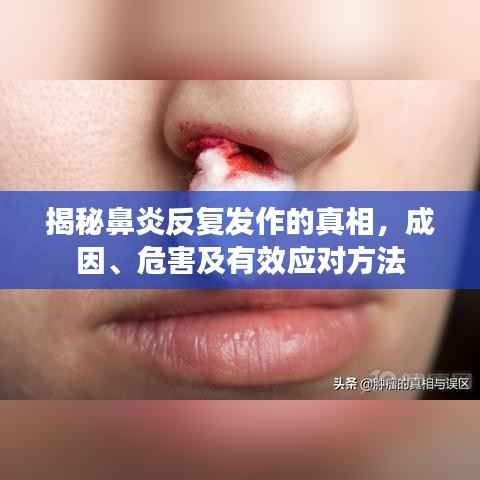 揭秘鼻炎反复发作的真相，成因、危害及有效应对方法